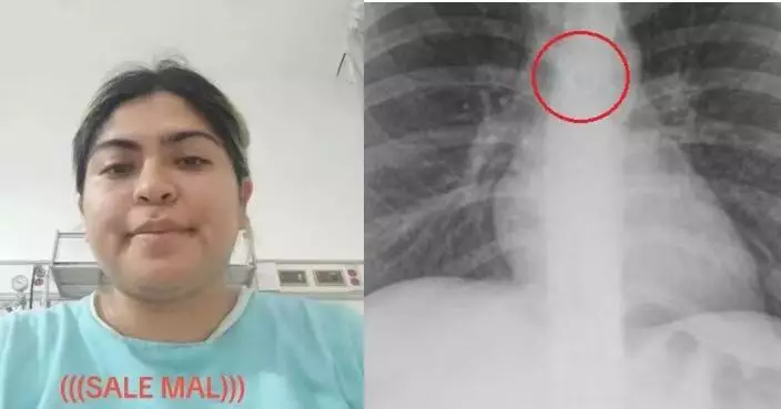 咳嗽1個月未見好轉 墨西哥女求醫揭鼻環誤入肺部距主動脈僅0.5毫米