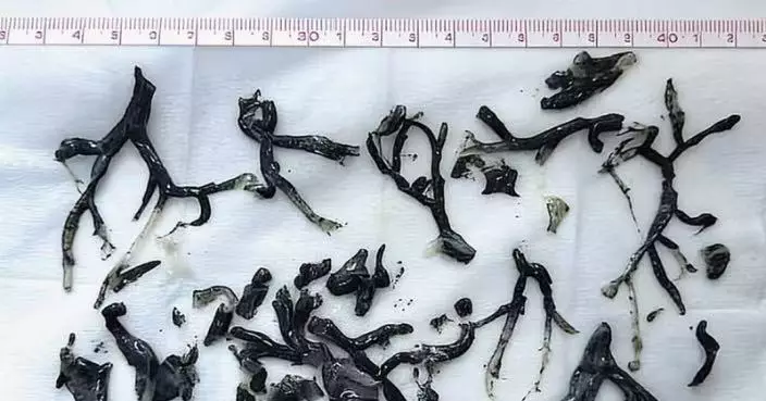 吸入大火濃煙後呼吸困難 8旬翁求醫驚揭肺部長滿「樹枝狀黑物」確診罕見疾病