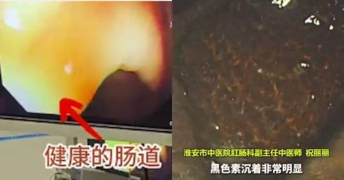 便秘10年長期靠通便茶紓緩 西安婦腸道變「豹紋腸」病變壞死需切除30CM