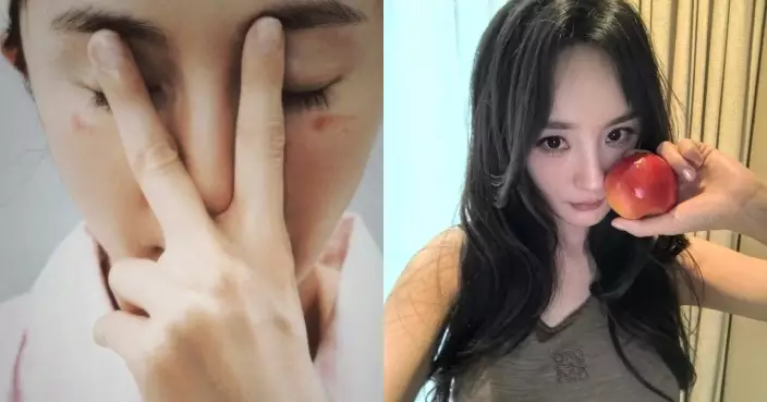 楊冪護膚變意外！ 蒸汽眼罩燙傷眼受傷