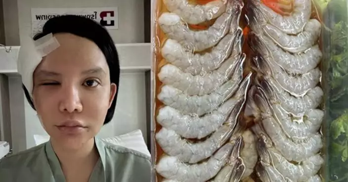 泰女食自製醃生蝦「寄生蟲鑽眼眶」險失明！醫生警告：半生不熟淡水水產可致命