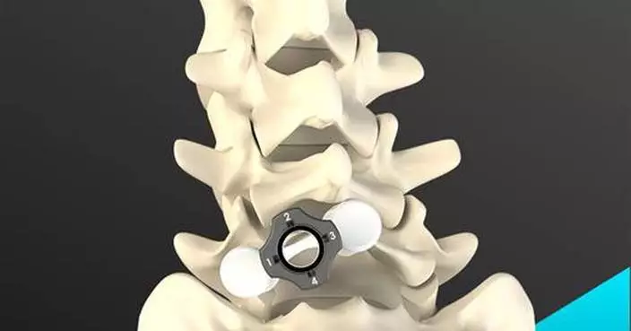 艾利維安醫療「慧視」獲FDA批准 創新即棄系統簡化脊椎減壓