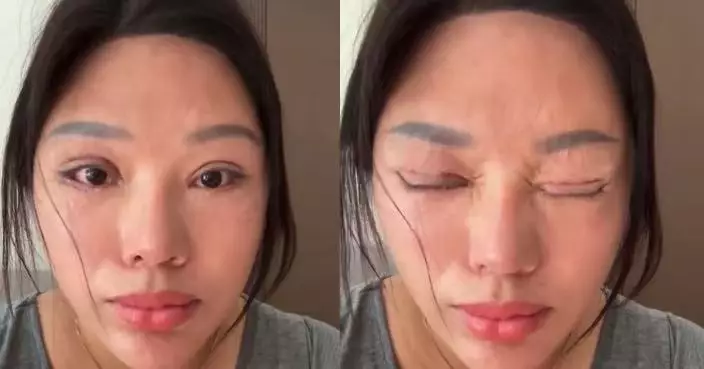 割雙眼皮後無法閉眼 江蘇女只能睜眼瞓覺淚流不止 被鑑定為九級傷殘