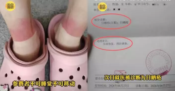 深圳女參加戶外「躺平大賽」疑被曬傷　腳踝現大片紅斑　主辦方：已承擔醫藥費