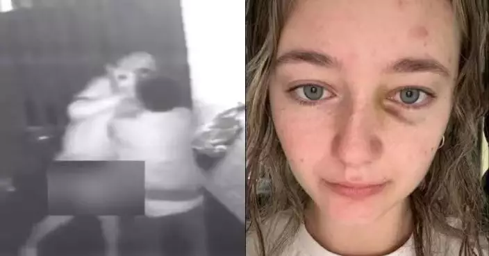 夜店外拒絕男子搭訕 英女遭對方重拳打斷鼻樑昏迷5分鐘留心理陰影
