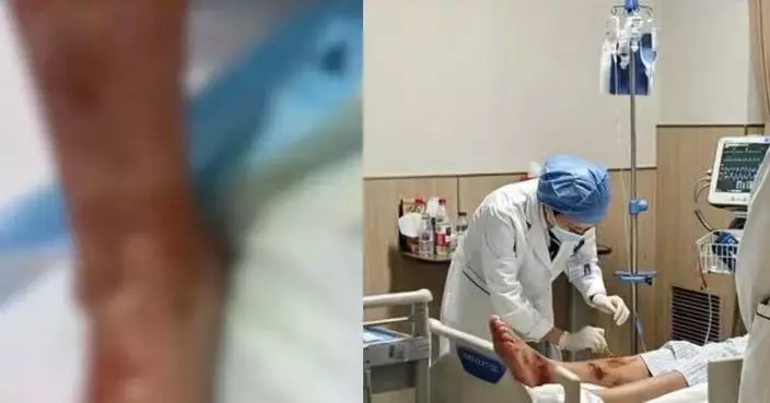 普通感冒險釀截肢危機 內地6旬婦高燒40℃右腿紅腫流膿揭糖尿病足感染