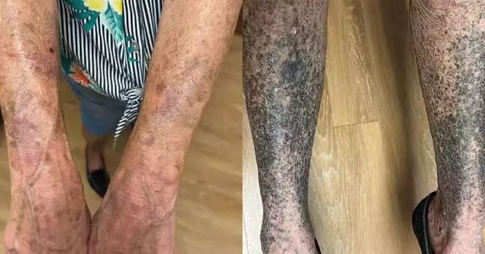 患皮膚炎求醫獲醫生開常見抗生素 美婦服用2周後「皮膚變藍灰色」