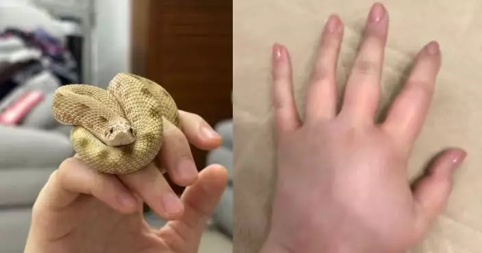 疑手上沾染老鼠尿味 江蘇女餵寵物蛇被誤當獵物咬傷 手部半小時腫如氣球