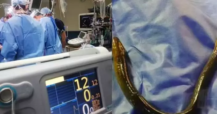 好奇塞活黃鱔入肛門滯留2小時 河南男童腹痛求醫取出 醫生警告可致腸穿孔