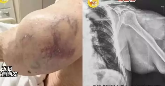 肩扛巨瘤逾10年皮膚險被撐破 陝西9旬翁經歷2小時手術終卸沉重負擔