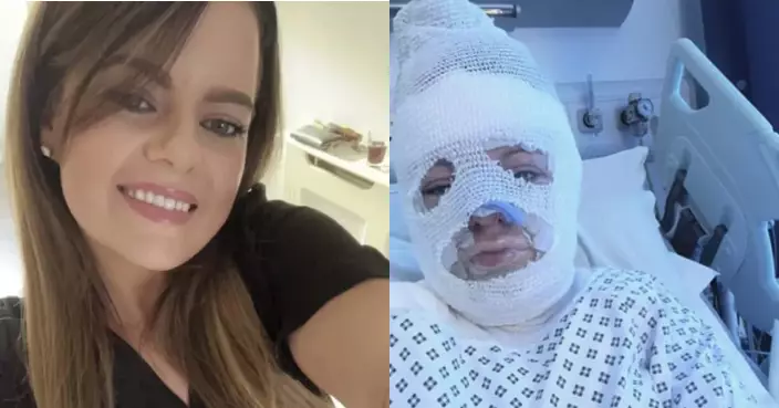聚餐遇酒精壁爐爆炸 英女遭火焰吞噬全身重度燒傷 復康路漫長婚姻也終結