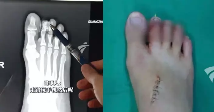 著人字拖邊行路邊睇手機 廣州少年踢中鋒利石塊致腳趾斷開需再植