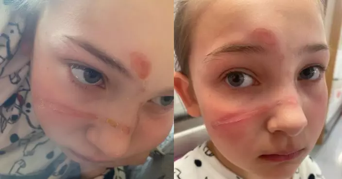 模仿TikTok挑戰放紓壓球入微波爐叮熱 英女童遭噴射填充物灼傷臉部留長疤