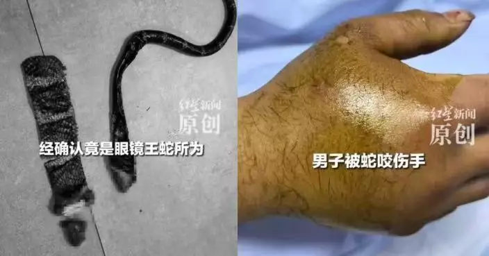 雲南村民勞作突遭2米眼鏡王蛇咬傷命危 醫院連夜調血清搶救3日3夜救回一命