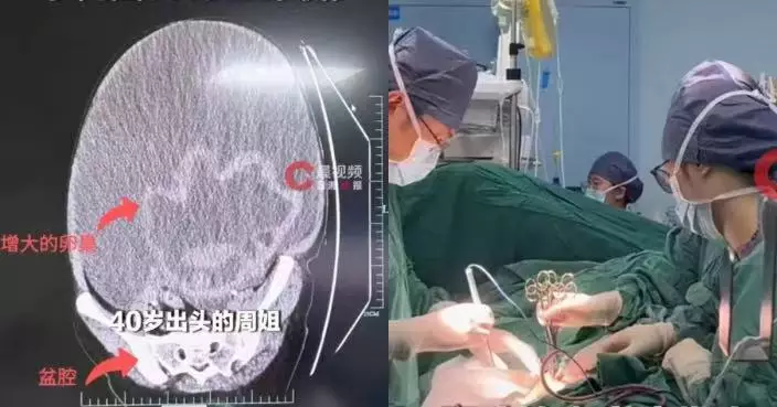 食量不大體重卻近90KG 浙江婦摔倒腹痛求醫驚揭體內藏巨大卵巢腫瘤