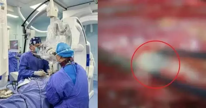 腰腿劇痛2年險癱瘓 福建婦手術揭脊髓藏上千條寄生蟲