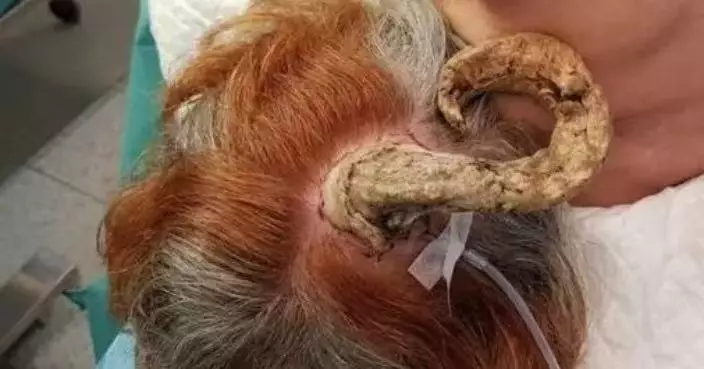 國外婦後腦長26cm腫塊如「獸角」！親友疑邪靈附身　求醫揭惡性皮膚癌