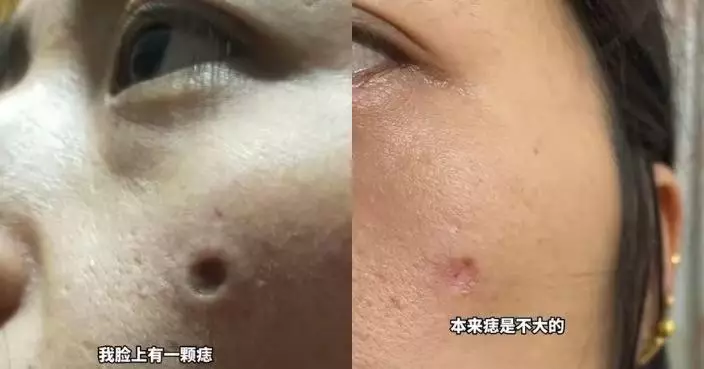 福建女藥水點痣臉上反留兩倍大深坑 7個月後疤痕增生直呼崩潰
