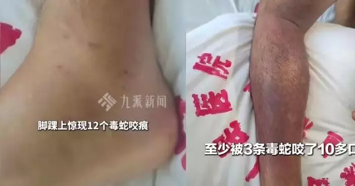 山區返工疑踩蛇窩遭多蛇狂咬 雲南漢一度休克昏迷 送院搶救5日撿回一命
