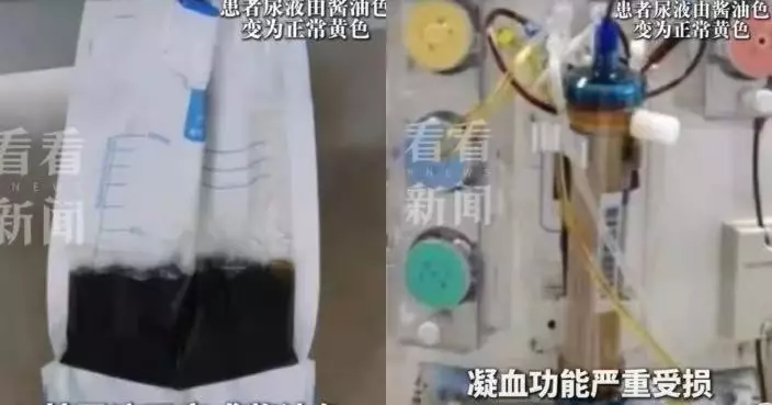 家中清理舊物遭五步蛇咬傷 杭州5旬漢送院檢查尿液已呈醬油色