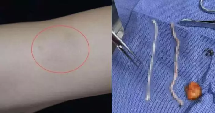 深圳女手臂腫塊切開鑽出兩條10CM活蟲 疑砧板刀具生熟不分染裂頭蚴