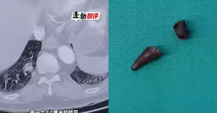 西安嗜辣老翁肺部現2.1釐米結節遭疑肺癌 醫生切開驚見0.5釐米辣椒尖