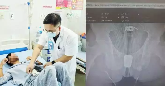 一時興起將馬桶沖洗器塞入肛門 越南漢噴頭卡直腸送院開腹2小時取出