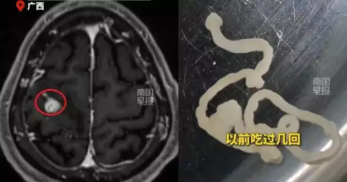 手軟到夾不起菜 廣西男求醫揭顱內藏5CM活寄生蟲 疑長期吃生食飲生水惹禍