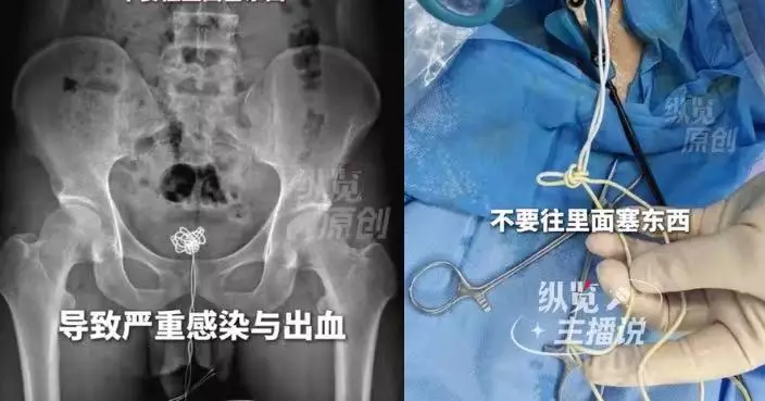 好奇將25CM數據線塞入尿道 深圳男死撐12小時腹痛尿血始求醫取出