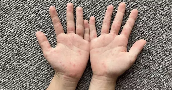 葉柏強：手足口病活躍程度升 新學年後加速在兒童之間傳播