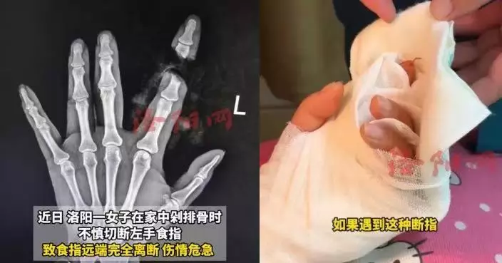剁排骨切斷左手食指 河南女獲醫院逾1小時完成斷指再植手術恢復手指血運