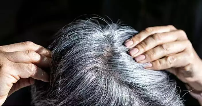 頭髮早白未必只是衰老 中醫：或與腎精、血虛、壓力及睡眠有關
