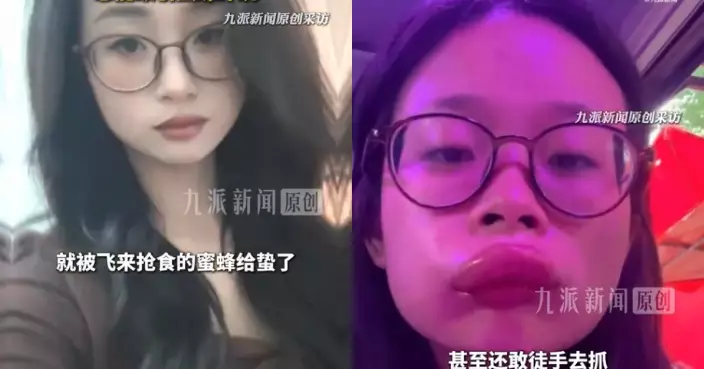 試食蜂糖李遭蜜蜂蟄嘴 貴陽靚女翌日嘴腫成「香腸唇」3日始消腫