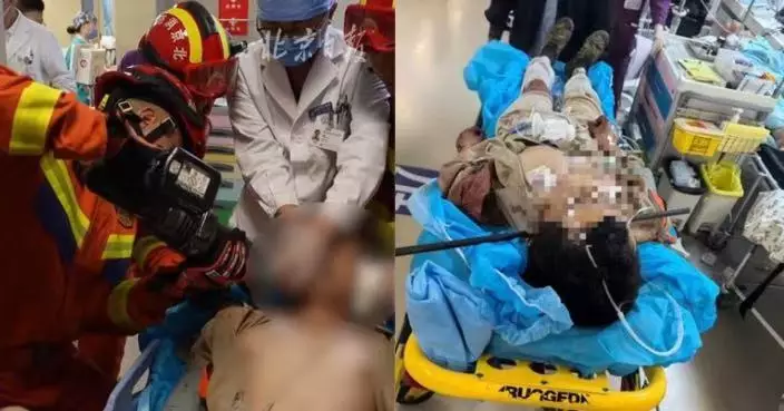 北京男工人高處墮下臉部遭1.5米鋼筋刺穿 醫生歷時2小時手術助完整取出