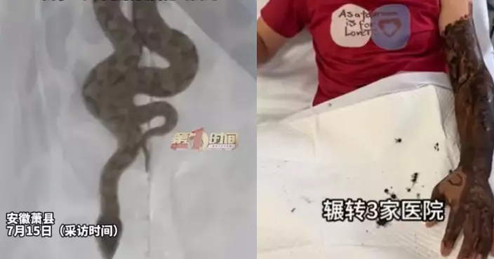 熟睡遭毒蛇咬傷 安徽女手臂腫至腋下發紫 搜屋一日揭短尾蝮藏梳妝櫃後