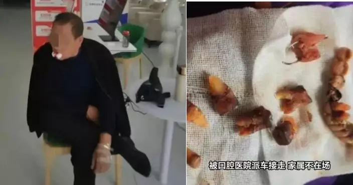 免費檢查變全口植牙？ 陝西翁遭剝12粒牙再植10粒 逾2萬積蓄被刷光