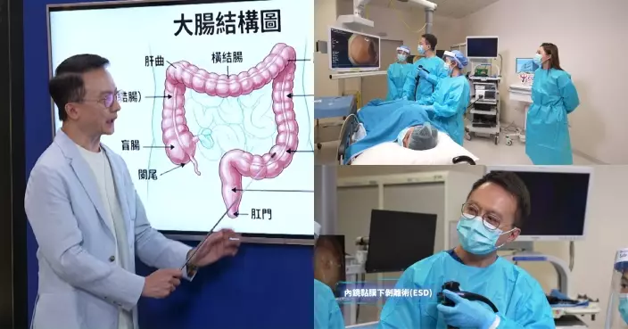 重症解密｜國際知名腸胃病學專家陳家亮親授預防大腸癌關鍵 林秀怡直擊ESD微創術切除大腸瘜肉