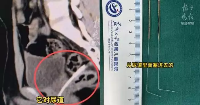 塞兩根10CM針灸針入尿道 江蘇少年羞於啟齒隱瞞近兩周感染性休克被送ICU