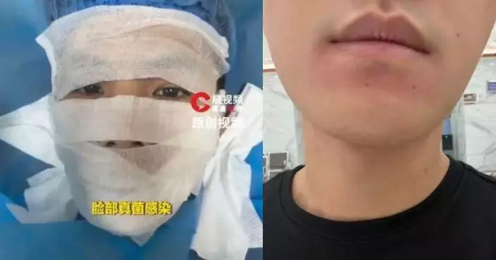 做Gym摸器材後用手擦汗 廣東男翌日嘴邊紅腫痕癢染真菌 專家教3步防護