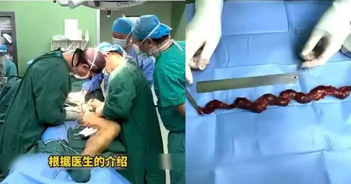 腿痛難行求醫 北京長者揭下肢靜脈藏40CM巨型血栓 醫生：脫落可致命