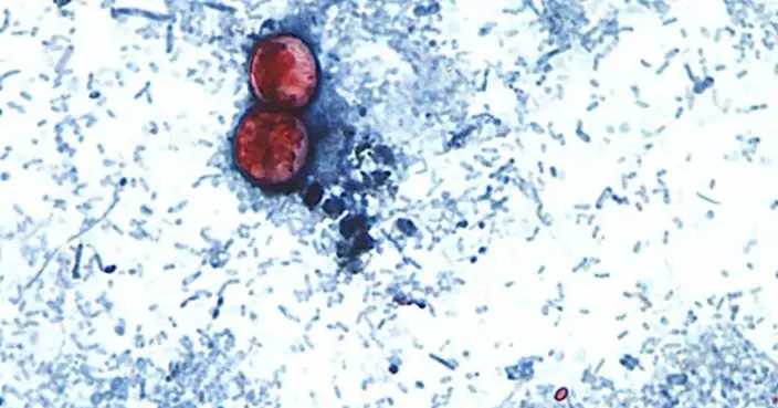 美國爆環孢子蟲感染疫情 17州145宗確診 密歇根州病例數日暴增逾570宗
