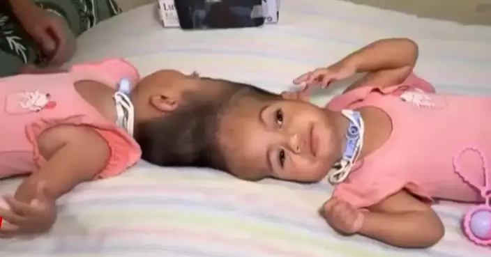 歷15小時手術成功分離頭部 巴西2歲連體孖生姊妹術後雙雙心臟驟停不治