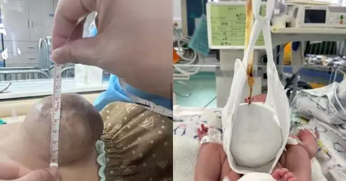 男嬰出生腹掛10CM包塊肝胃腸外露 武漢醫護研發懸吊帶助器官歸位