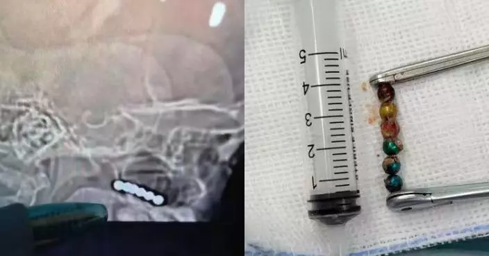 深圳男童撞傷頭部求醫驚揭鼻藏6粒磁力珠 左右互吸長年壓迫鼻中隔險致穿孔