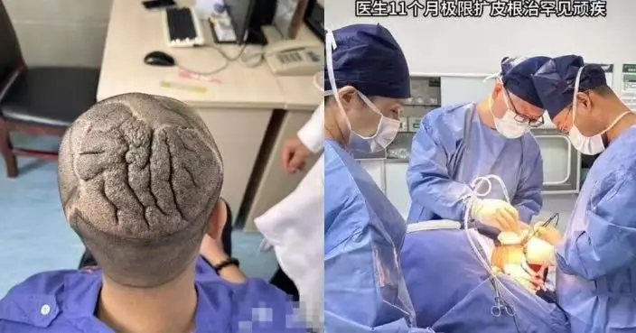 患罕見頭皮病近10年 湖南漢頭皮增厚皺褶似「大腦」 手術恢復正常