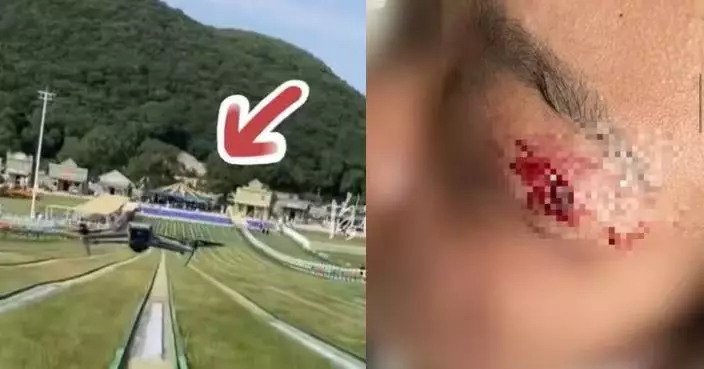 景區滑草突遭無人機迎面撞擊 內地女臉部爆血險傷左眼幸戴眼鏡阻擋