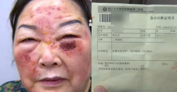 花逾2萬醫美「祛斑」 杭州7旬婦術後臉部腫痛脫皮徹夜難眠 求醫揭二度燒傷