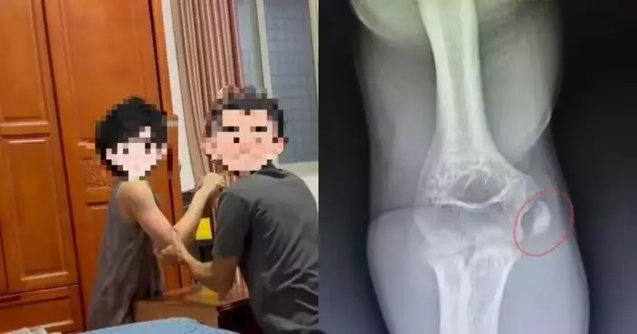 福建父子拗手瓜較勁 僵持不下突傳骨裂聲 兒子手肘當場骨折躺醫院