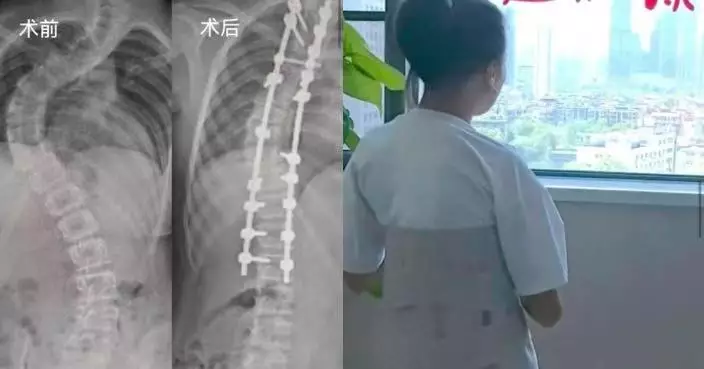 脊柱側彎逾80度 湖北少女高低肩駝背陷重度畸形 手術後挺直腰背增高7CM