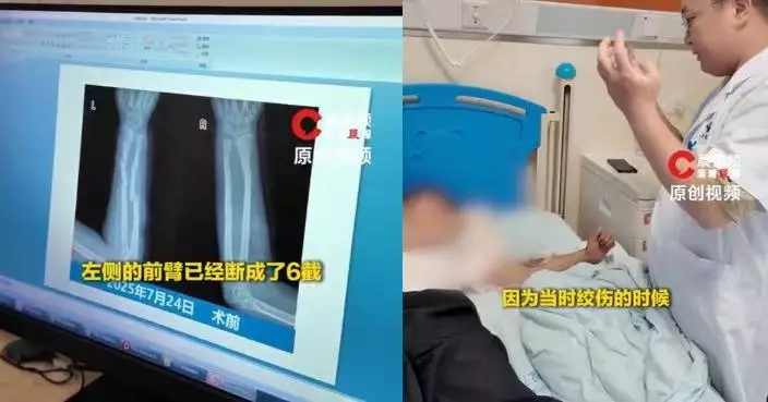 清洗和麵機雙手遭捲入 湖南女童前臂骨頭碎成10段 經3次手術恢復抓握功能